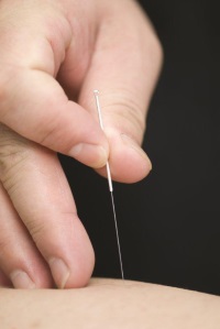 Fysiotherapie van Berkel - Dry Needling